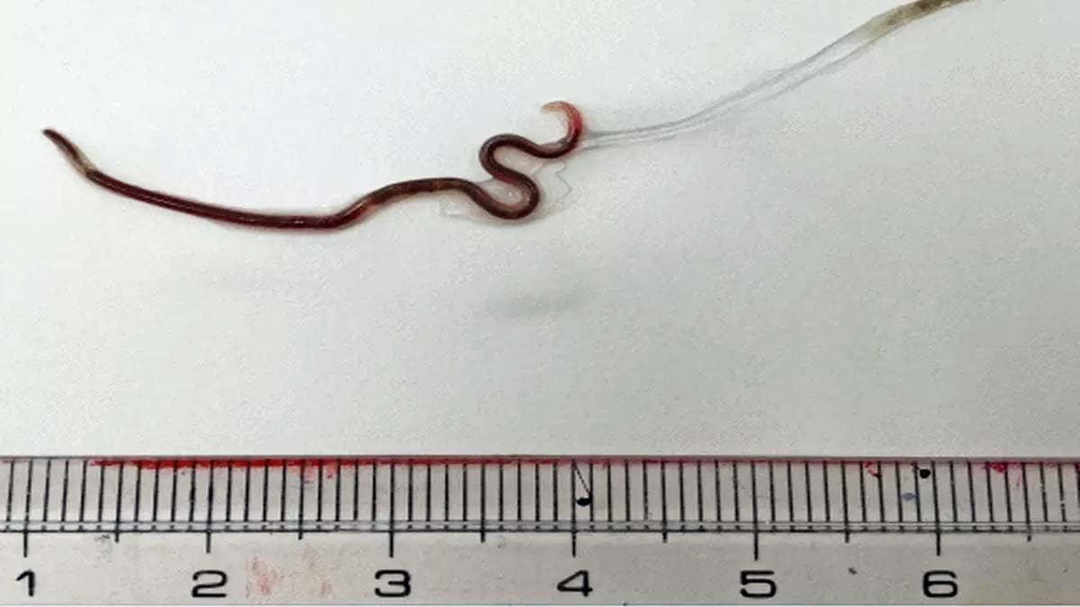 Vídeo | Japonesa é diagnosticada com verme na garganta após comer sashimi