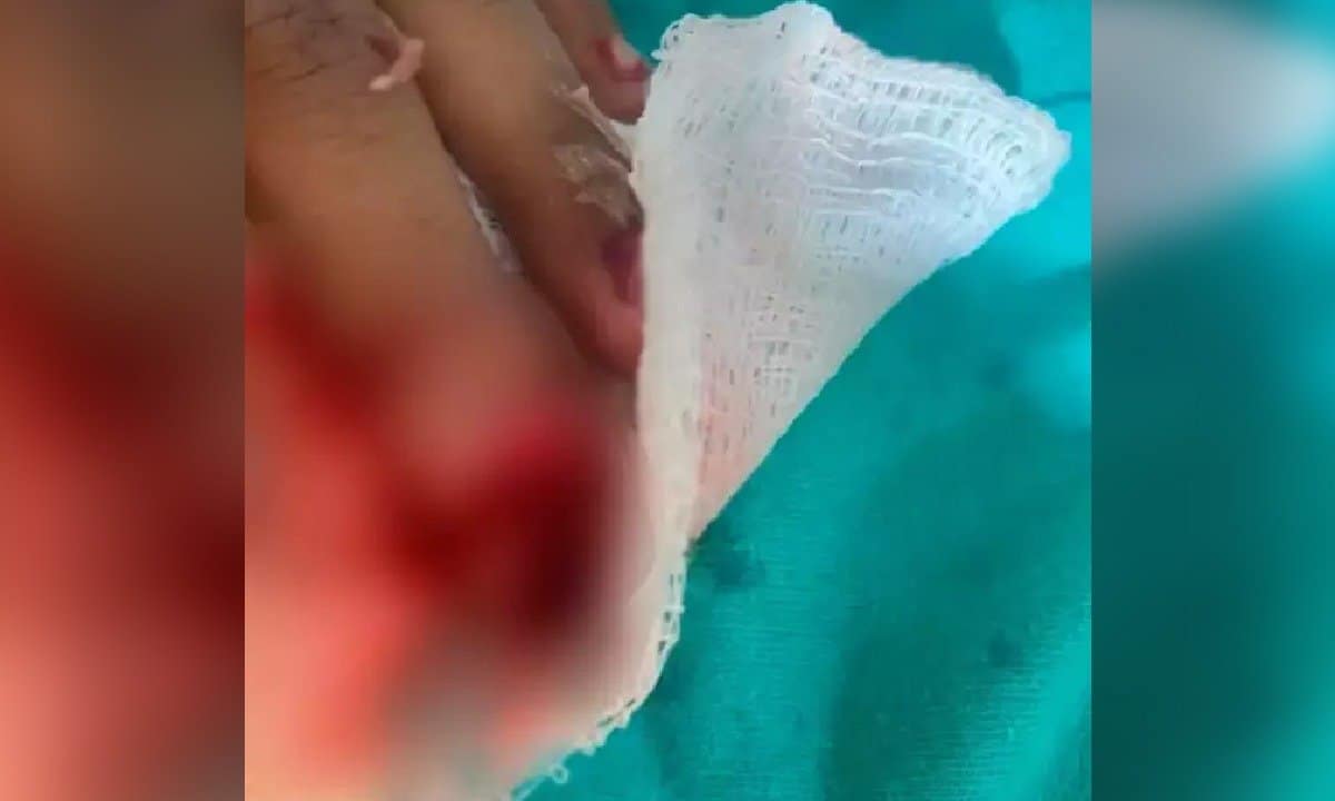 Criança de 6 anos perde dedo após acidente em academia pública de Campo Grande