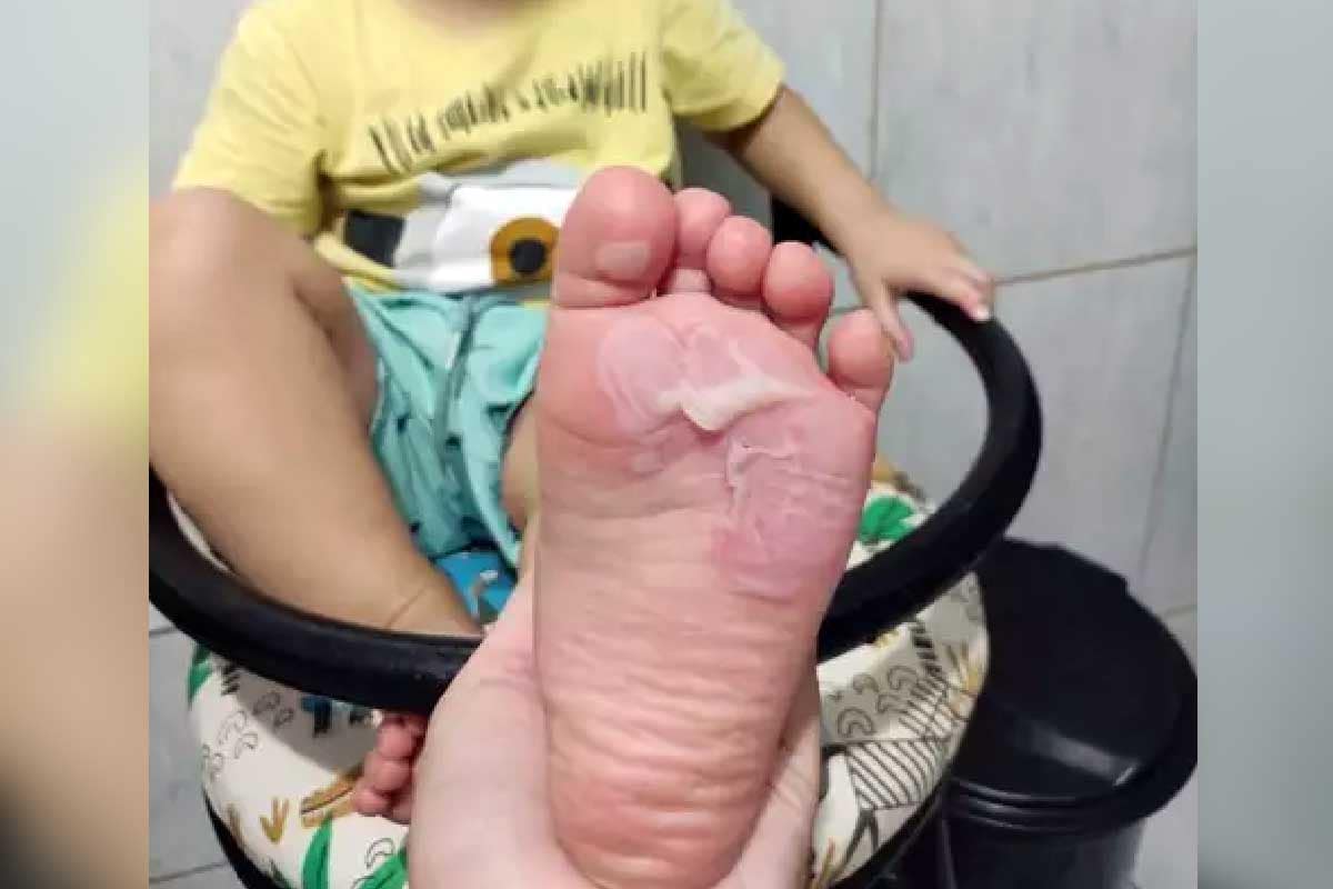 Escola é acusada de negligência após bebê ter pés queimados em Campo Grande