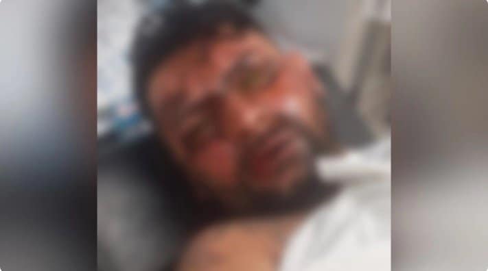 Tatuador perde a visão após ser atacado pela ex-namorada com soda cáustica em Campo Grande